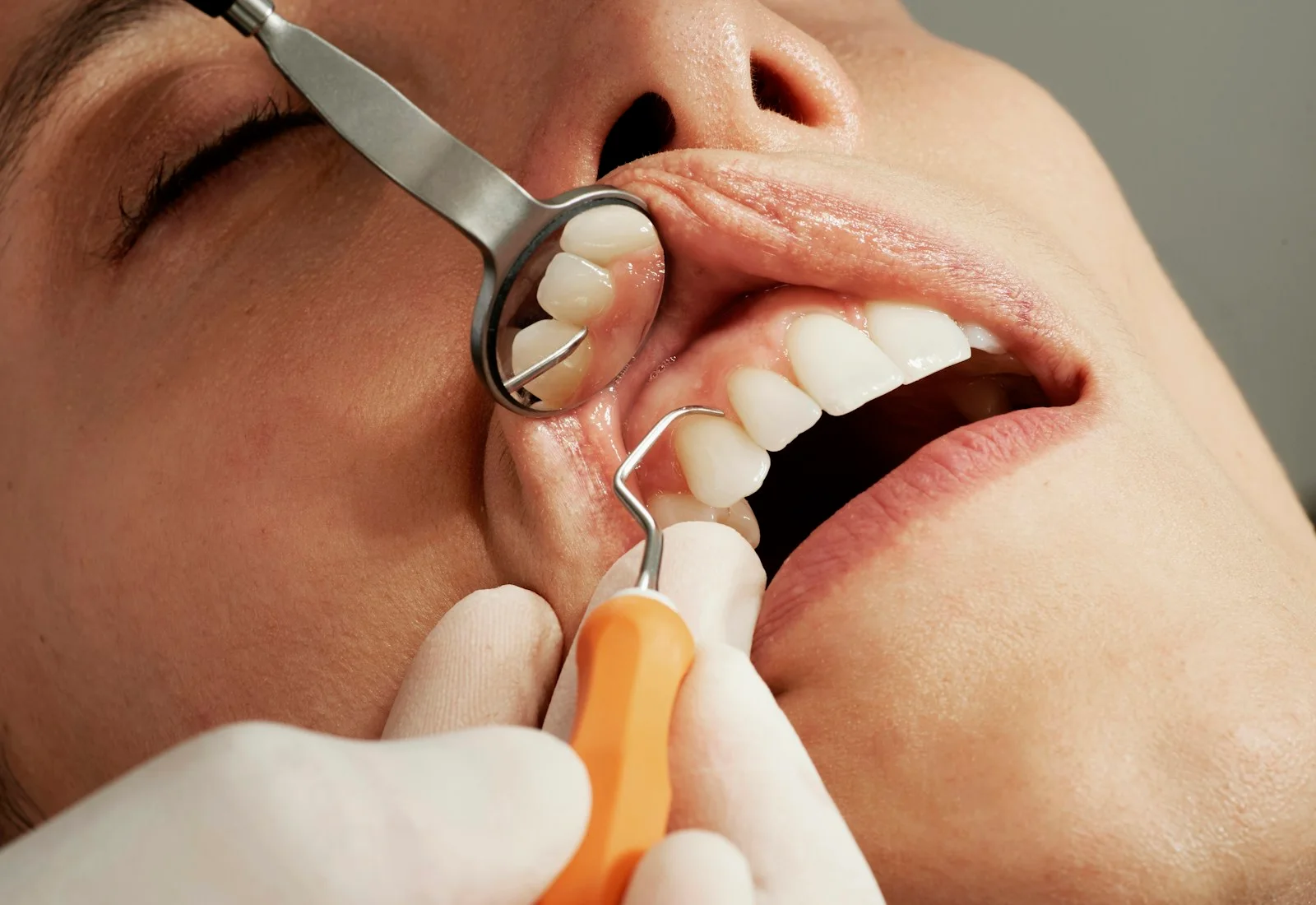 Smile assessment for clear aligners